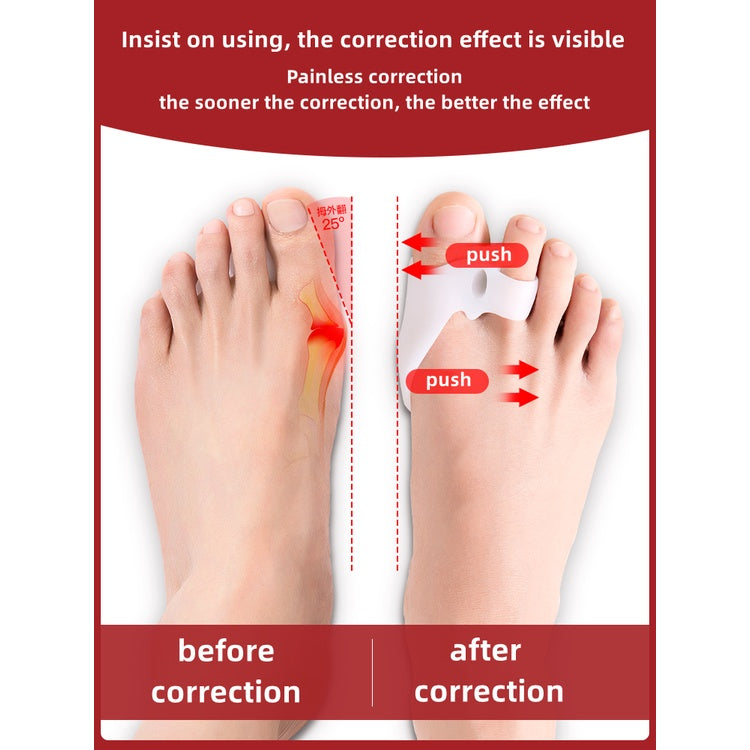 Toe Straightener - 1 Pair